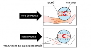 Чулки антиэмболические 1 класс Ergoforma (арт. 217) фото 2708